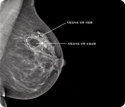 자가지방 이식 비교 사진 1