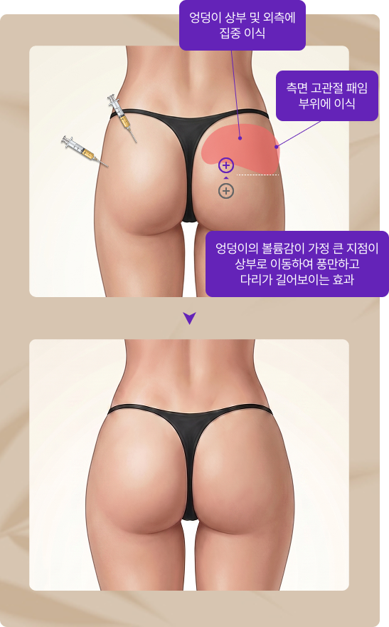 힙업/골반 이식 부위 참고 사진 2